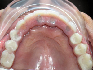 Implant After