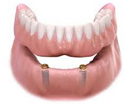 Implant Denture Removable