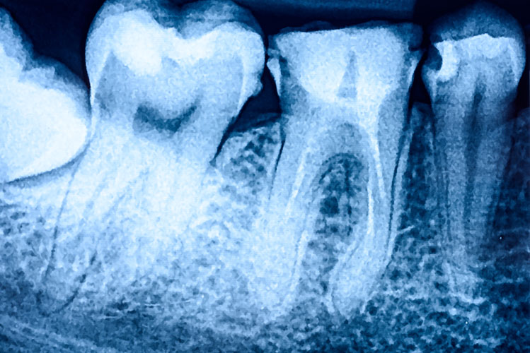 Prevent Bone Loss After Tooth Loss