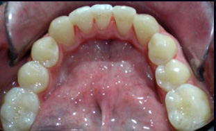invisalign after