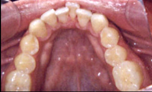 invisalign before