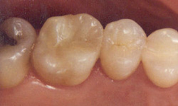 onlay after cosmetic implants