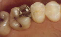 onlay before dental implants